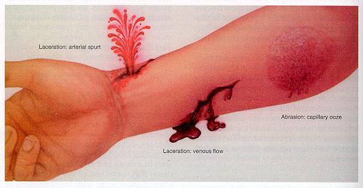 Hemorragias capilar Ocorre devido à rutura dos minúsculos vasos capilares de uma ferida. Esta hemorragia é de fácil controlo, podendo parar espontaneamente. ARTERIAL VENOSA CAPILAR Fig. 7.1.