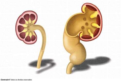 ALTERAÇÕES NAS PRESSÕES ENVOLVIDAS NA FILTRAÇÃO GLOMERULAR (alterações nas forças de Starling) Alterações