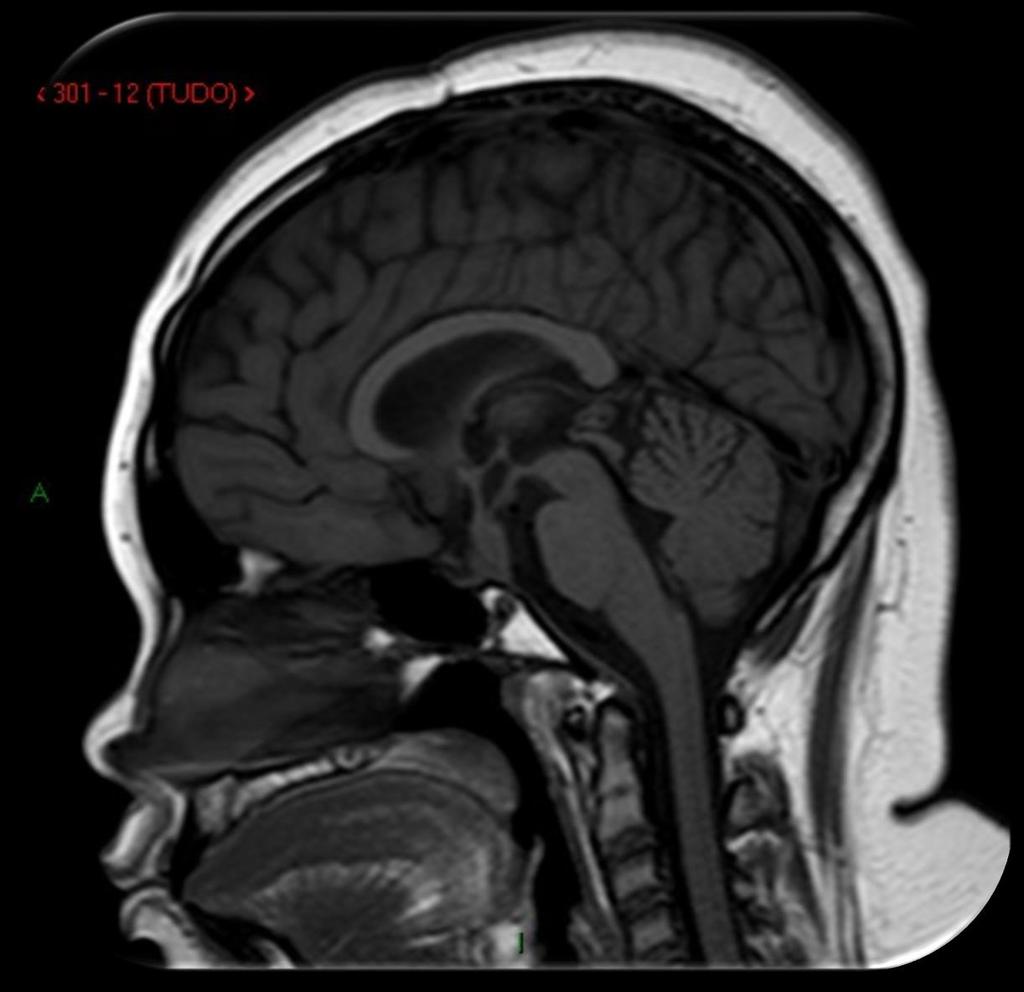 Lobo parietal Lobo occipital Lobo frontal Cerebelo Seio frontal Aqueduto cerebral 3 ventrículo