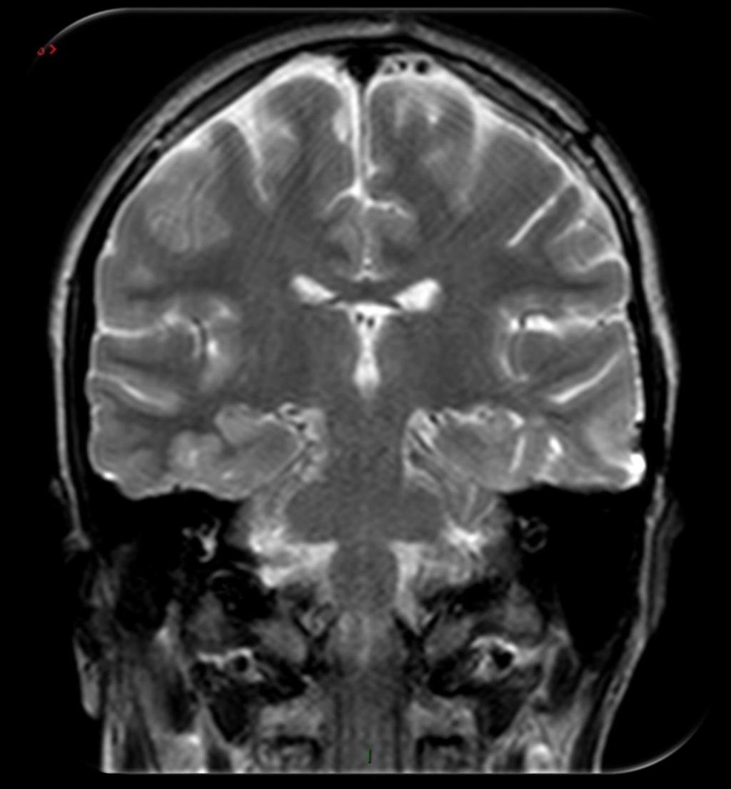 Lobo frontal Lobo temporal Lobo parietal Pedúnculo