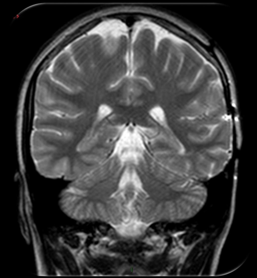 Ventrículo lateral Cisterna