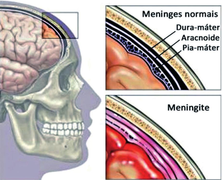 136 sic infectologia 1. Definição Importante A presença ou ausência de função cerebral normal é importante para distinguir entre meningite e encefalite.