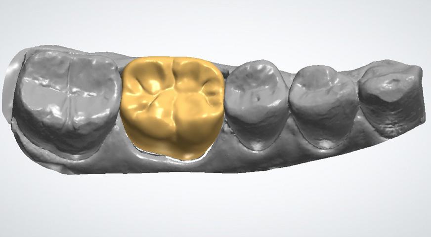 O software Model Builder (3Shape) foi usado para reorientar os dados da digitalização, definir o plano de oclusão e identificar as margens do dente preparado.