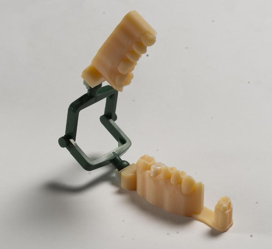 Figura 10: Modelo dental impresso com matriz não removível. rentabilidade.