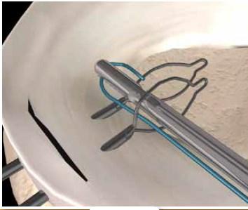 Segure uma extremidade da sutura trançada com uma pinça.