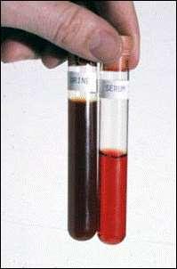 DHRN em Potros Recém-Nascidos The yellow discoloration of plasma from a neonatal foal indicates icterus.