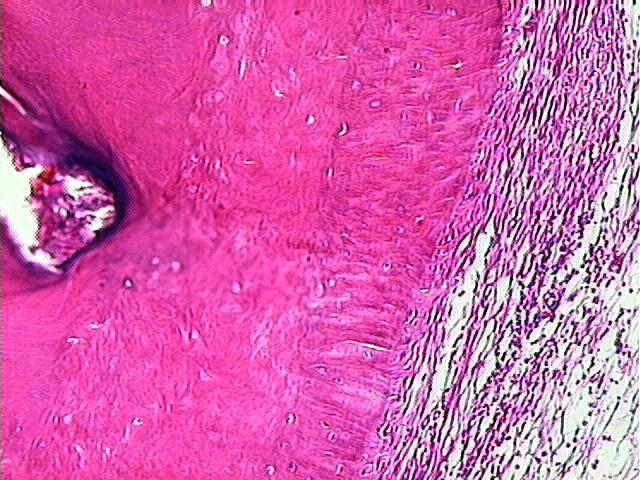 Observar presença de canal lateral (seta) e, adjacente a esta zona, infiltrado inflamatório localizado junto ao ligamento