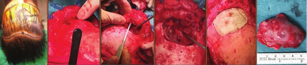 FIGURA 3. Cirurgia multidisciplinar com ORL e Neurocirurgia.