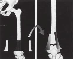 PROPOSTA DE TRATAMENTO COM ENXERTO ÓSSEO CORTICAL HOMÓLOGO PARA A FRATURA DISTAL DO FÊMUR PÓS-ARTROPLASTIA TOTAL DO JOELHO A B A B Fig.