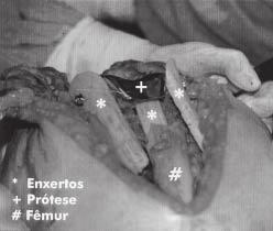 4 Controle radiográfico pós-operatório imediato em (A) frente e (B) perfil. Fig. 4 Post-op aspect in (A) AP view and (B) lateral Fig.