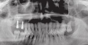 11 Imagem radiográfica panorâmica pós-operatória.