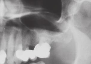 ELEVAÇÃO DO SEIO MAXILAR COM ACESSO LATERAL Elevação do seio maxilar com acesso lateral com ampla perfuração da membrana sinusal Prof.