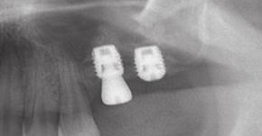 2 Imagem intraoperatória mostrando um osso alveolar fino após