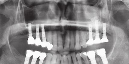 ELEVAÇÃO DO SEIO MAXILAR E ENXERTO ÓSSEO Elevação do seio maxilar de acesso lateral com 20 anos de acompanhamento Dr.