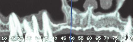 ELEVAÇÃO DO SEIO MAXILAR E ENXERTO ÓSSEO Elevação do seio maxilar com acesso lateral em 3D mediante a técnica de F. Khoury Dr.