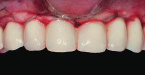 implantes dentários são colocados na posição 3D correta de acordo com o planejamento
