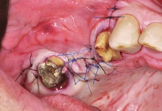 8 Vista oclusal do tecido regenerado por cirurgia implantar, 10