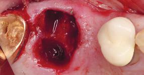 vestibular 1 Fratura da raiz do 16, tratamento de canal radicular fracassado e próximo do