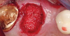 4 Extração do dente 16 sem elevar o retalho mucoperiostal de espessura total; parede alveolar