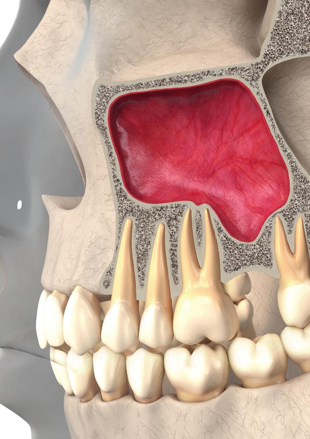Pneumatização secundária Ocorre após a extração dentária posterior em adultos e leva a um aumento do seio maxilar às custas do rebordo
