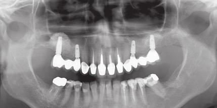 Ele relatou ter extraído um dente na região superior posterior direita há cerca de 3 meses atrás. O plano de tratamento visa uma restauração protética fixa.