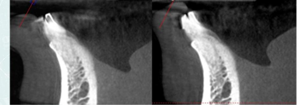 antes e depois da cirurgia, mordendo um mesmo ponto de referência.