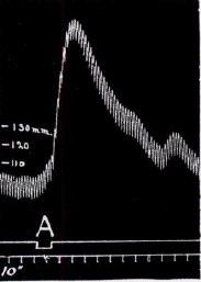 Pressão sanguínea Fig. 10. Gato: cérebro destruído. 1 mgm de Atropina previamente. Para A: 25 mgm Colina cloride IV.