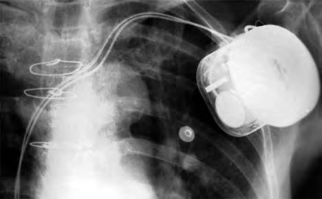 Em dezembro de 2002, recebeu implante de CDI Medtronic GEM III DR 7275, com eletrodos atrial 5076 e ventricular de choque 6943 de coil único e fixação ativa.
