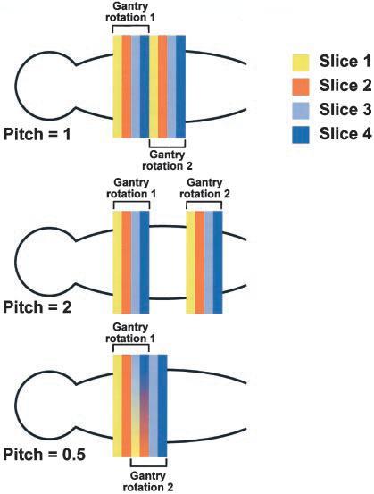 Figura 2.7 Diferentes aquisições de CT tendo em conta diferentes valores de pitch. (29) O Pitch é um dos parâmetros que influencia o valor de dose de radiação associado a cada exame de CT.