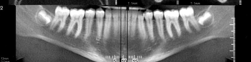 4 Material para obtenção do traçado na telerradiografia e tomografia Foram feitos dois traçados, sendo um da imagem da sínfise na telerradiografia e