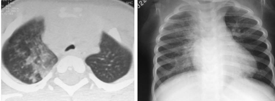 Opacidades em vidro fosco e nódulos do espaço aéreo do LSD, LID, com áreas de confluência no segmento apical do LID.