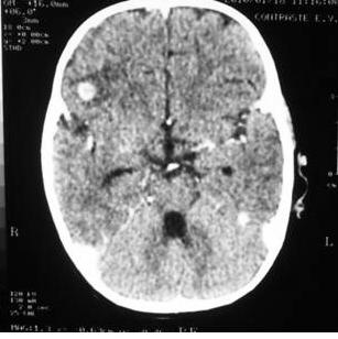 61 Figura 41. Meningoencefalite: Em A (caso 1), realce nodular frontal direito e cerebelar esquerdo (setas).