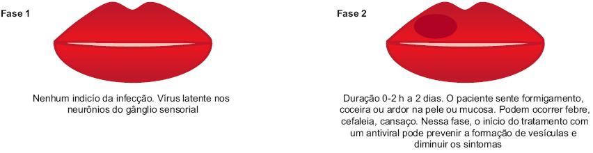 Herpes simplex-1