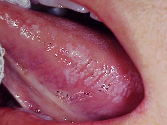 Vírus Epstein-Barr Infecção secundária - Após infecção primária