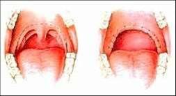 local Hidrólise (60 a 90 º C) Fibrose tecidual Submucosa Laser e eletrocautério rio: 750 a