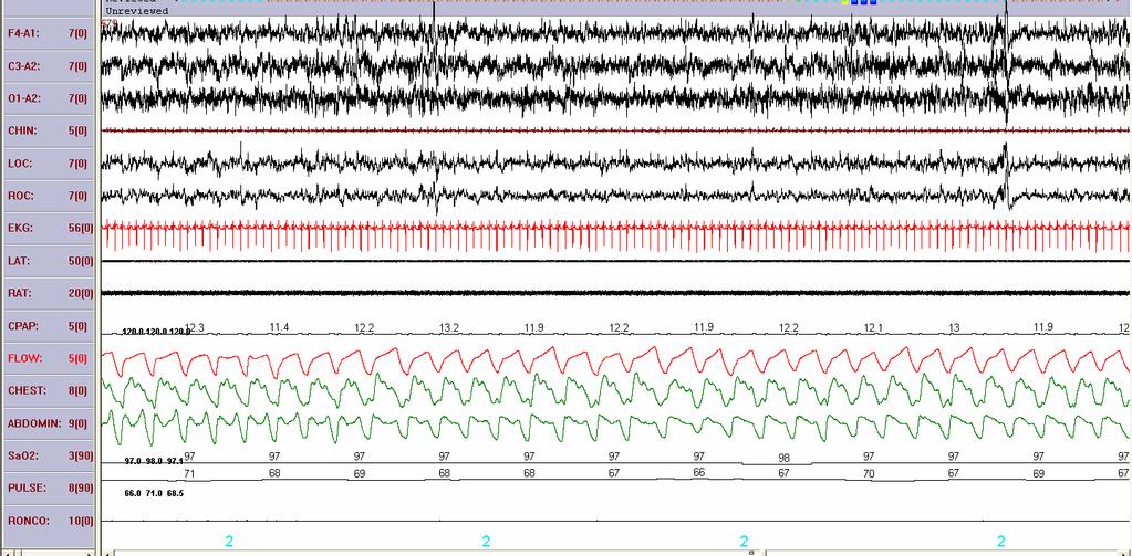 Sonolência excessiva (Epworth >10) HAS Obesidade (IMC >30 kg/m 2 )