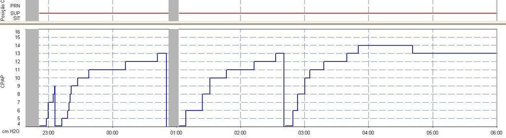 resposta clínica insatisfatória Titulação de CPAP = 10 cmh2o Pcte masc, 56