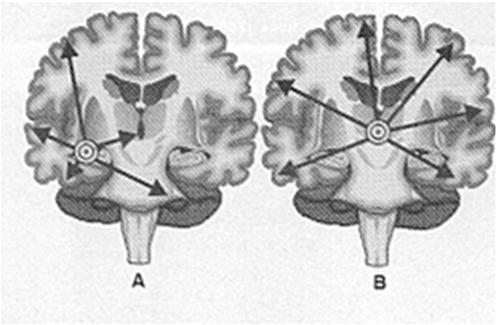 CLASSIFICAÇÃO Parciais: apenas uma parte de um hemisfério cerebral (corticais) Generalizadas: envolve uma área mais extensa dos dois hemisférios (talâmicas)