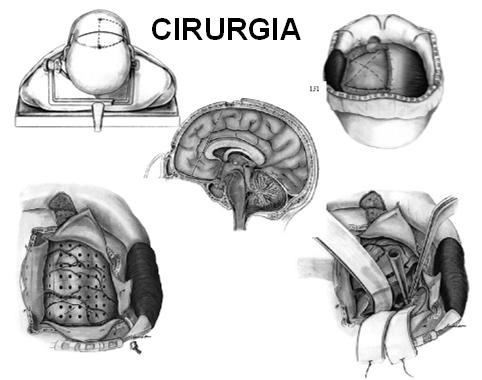 TRATAMENTO CIRURGIA MEDICAMENTOS Ataxia Diplopia, borramento visual Sedação Náuseas e vômitos