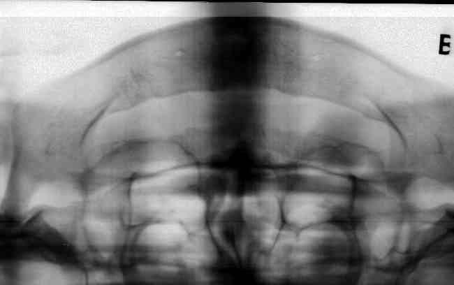 Material e Método 31 Figura 1 Exemplo de radiografia panorâmica