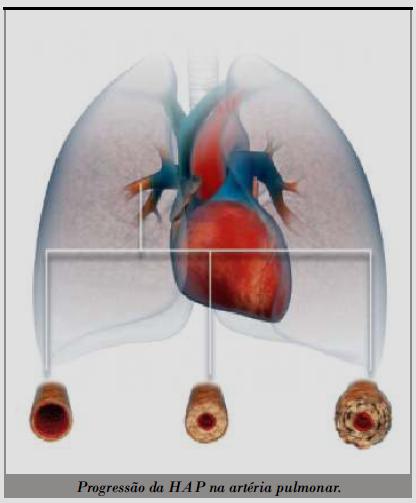 Hipertensão Arterial Pulmonar Prevalência: