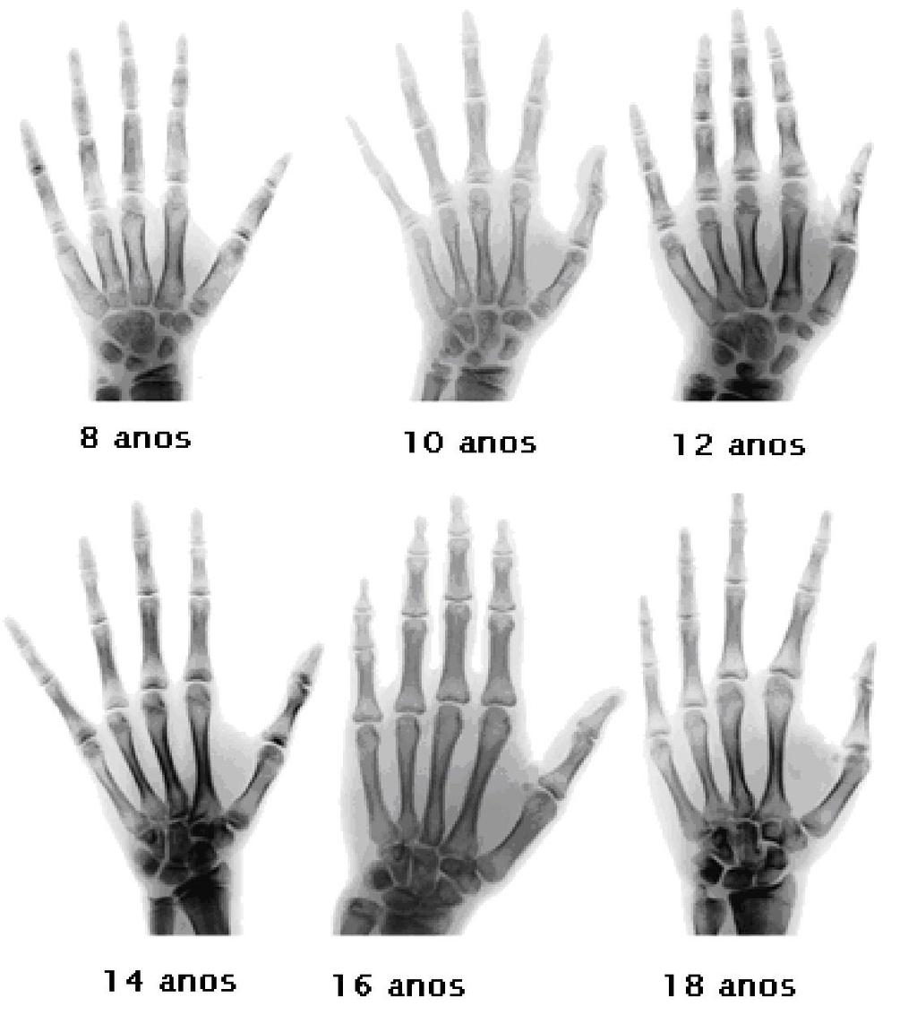 2.4 Principais Métodos de Avaliação de Idade Óssea Atualmente, existem diversos métodos disponíveis para avaliar a idade óssea de um determinado paciente.