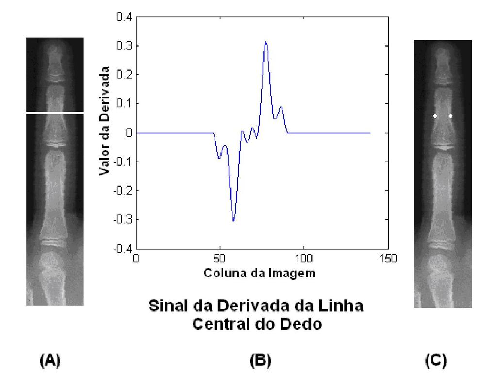 5.9 Detecção do Perfil das Falanges O próximo passo consiste em detectar os perfis esquerdo e direito de cada uma das falanges. Para tanto, toma-se o segmento horizontal na porção central da falange.