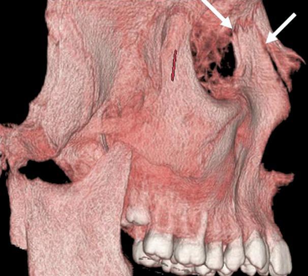 O padrão de expansão tem formato triangular, sendo que no plano coronal, a expansão tende a ocorrer nos processos alveolares e base óssea maxilar, próximo ao parafuso expansor, decrescendo em direção