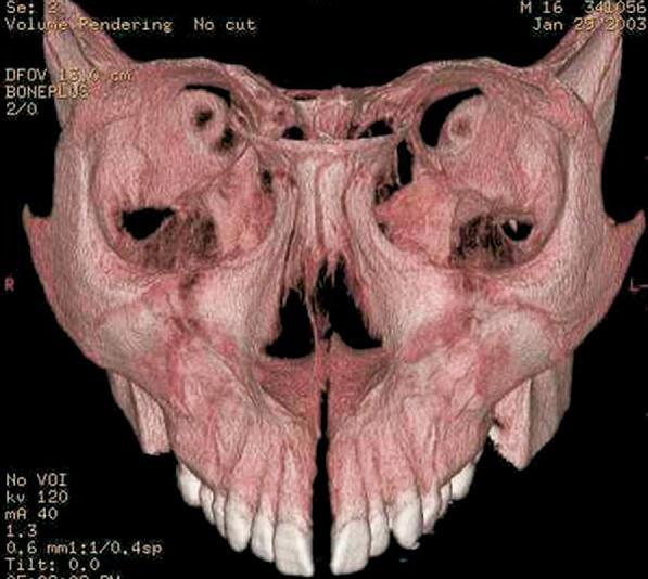33 Figura 2.3 - Padrão triangular da abertura da sutura palatina mediana na visão frontal (Fonte: Habersack et al., 2007) Silva Filho et al.