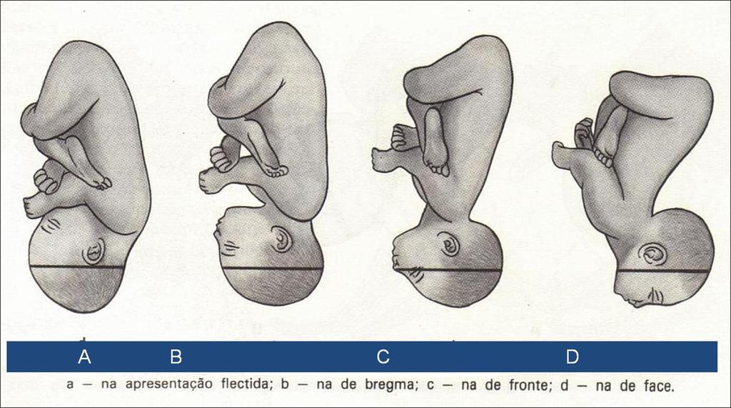 APRESENTAÇÃO CEFÁLICA FLETIDA (95,5%) DEFLETIDA (1%) primeiro