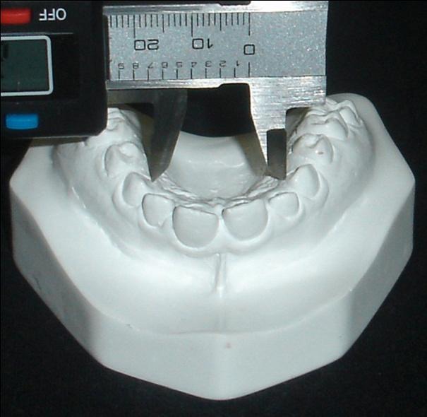42 profundidade era medida com a vareta do paquímetro, que correspondia à medida da linha perpendicular traçada da linha média palatina até o fio de aço inox que unia a região de cada um dos dentes