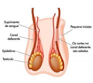 ??): Vasectomia: não libera