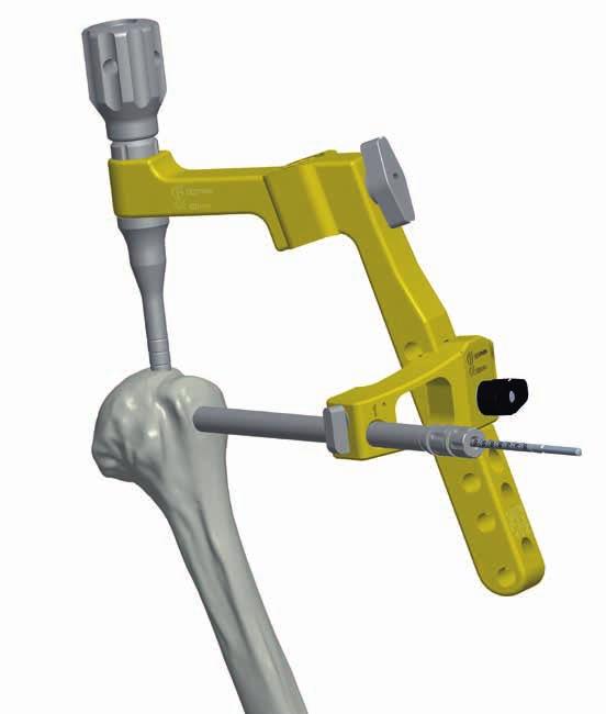 12 TÉCNICA CIRÚRGICA Bloqueio proximal São utilizados três parafusos de bloqueio totalmente roscados em titânio de 4.0 mm para o bloqueio proximal da cabeça umeral.