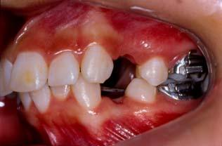 pré-molares Figura 4.
